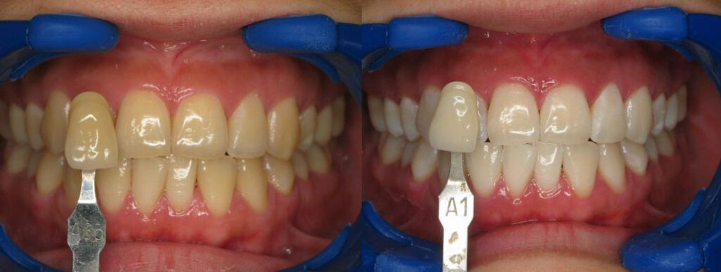 Perché i denti perdono luminosità con il tempo