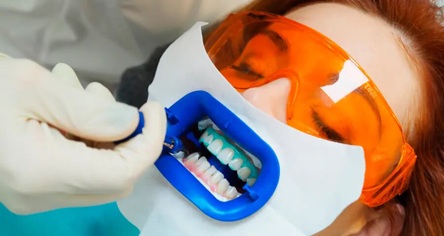 sbiancamento dentale