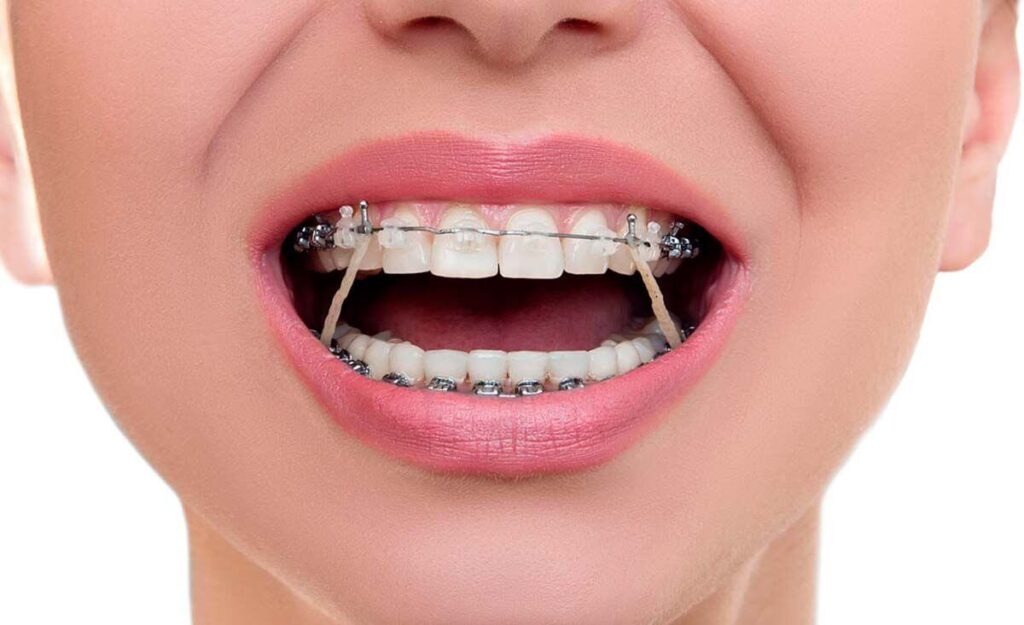 Elastici per apparecchio