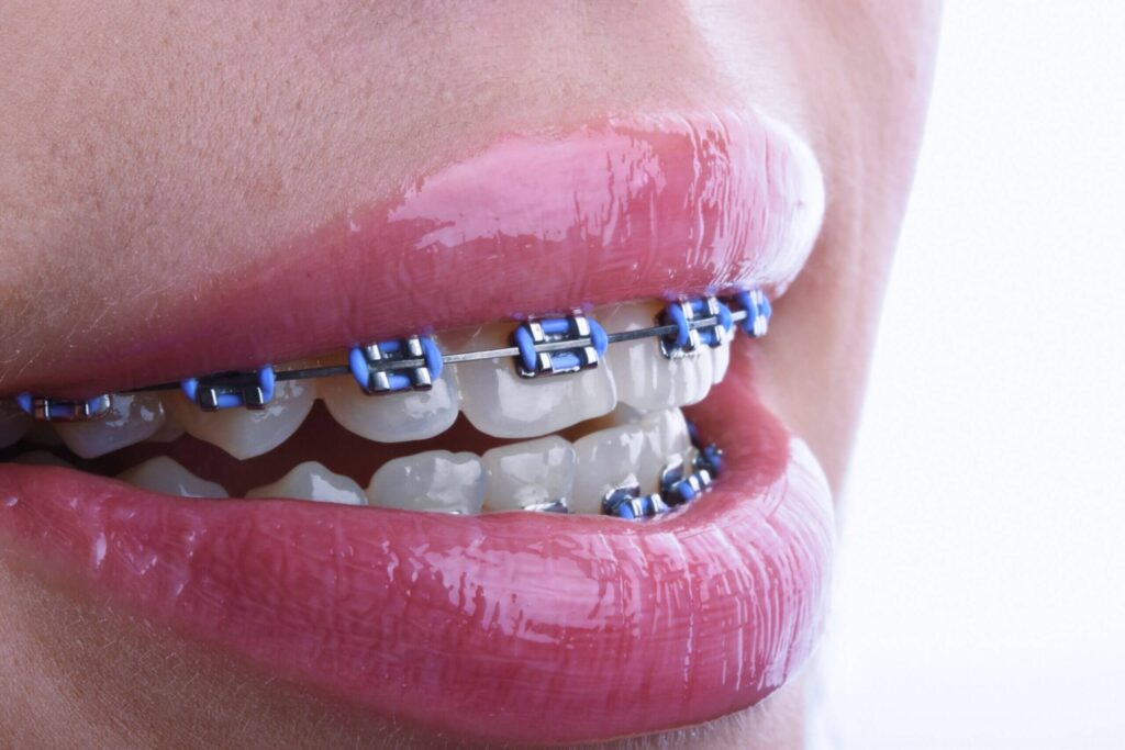 Elastici per apparecchio