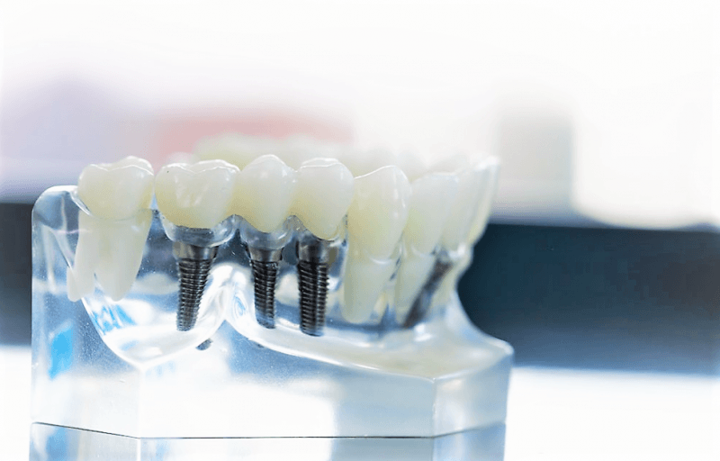 impianto dentale