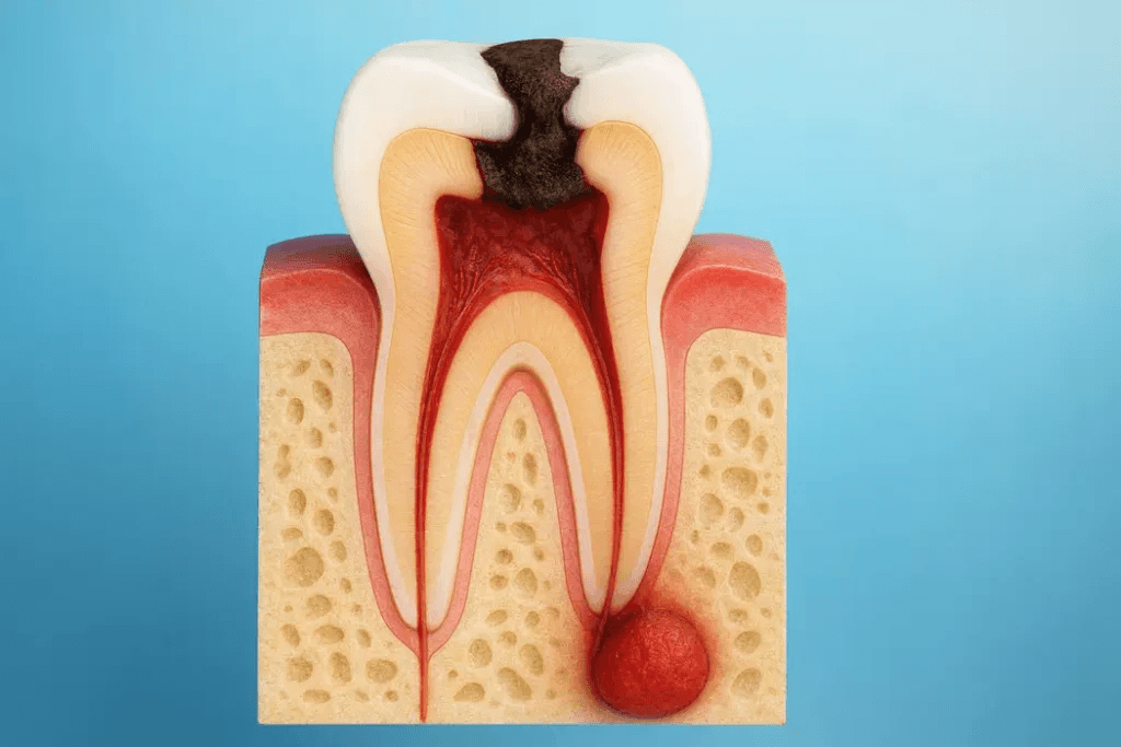 granuloma dentale