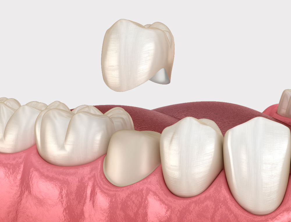 Corona dentale