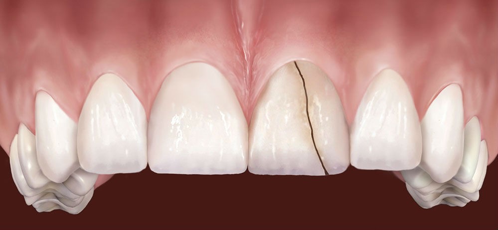dente rotto